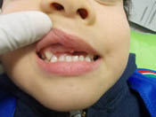 Kids Dentures - 4-3
