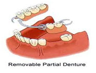 denture - removable 1
